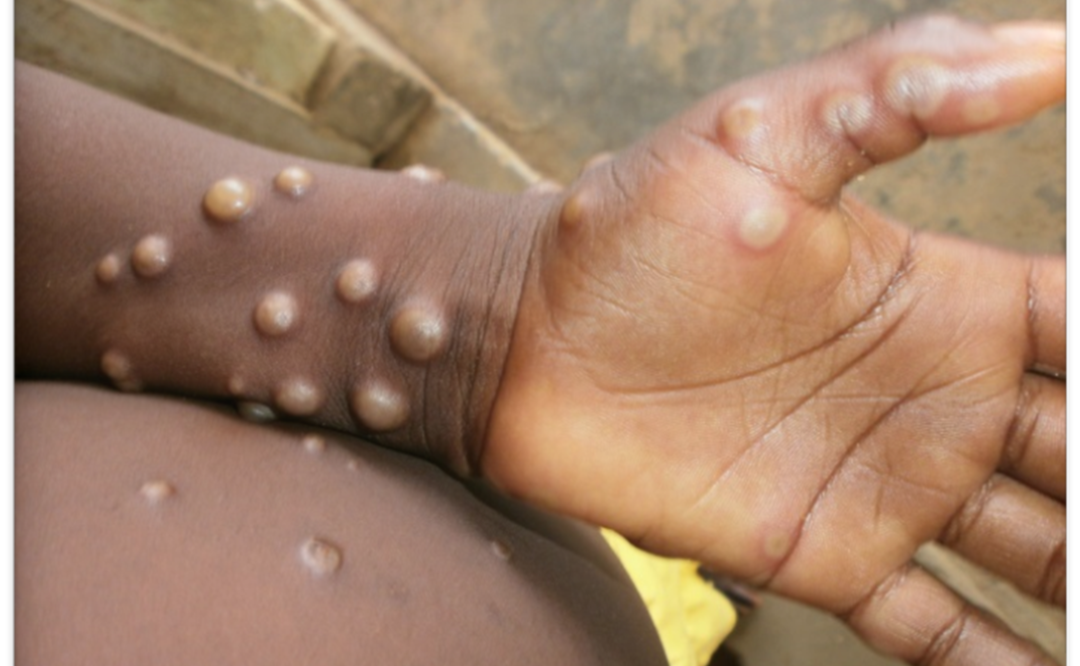 Foto: Nigeria Centre for Disease Control