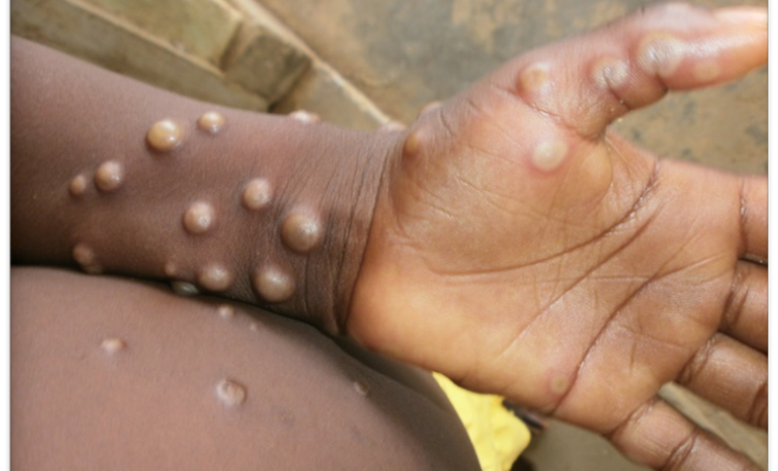 Foto: Nigeria Centre for Disease Control