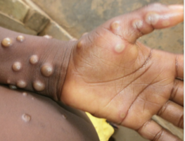 Monitorean a 200 personas en EU por exposición a viruela del mono