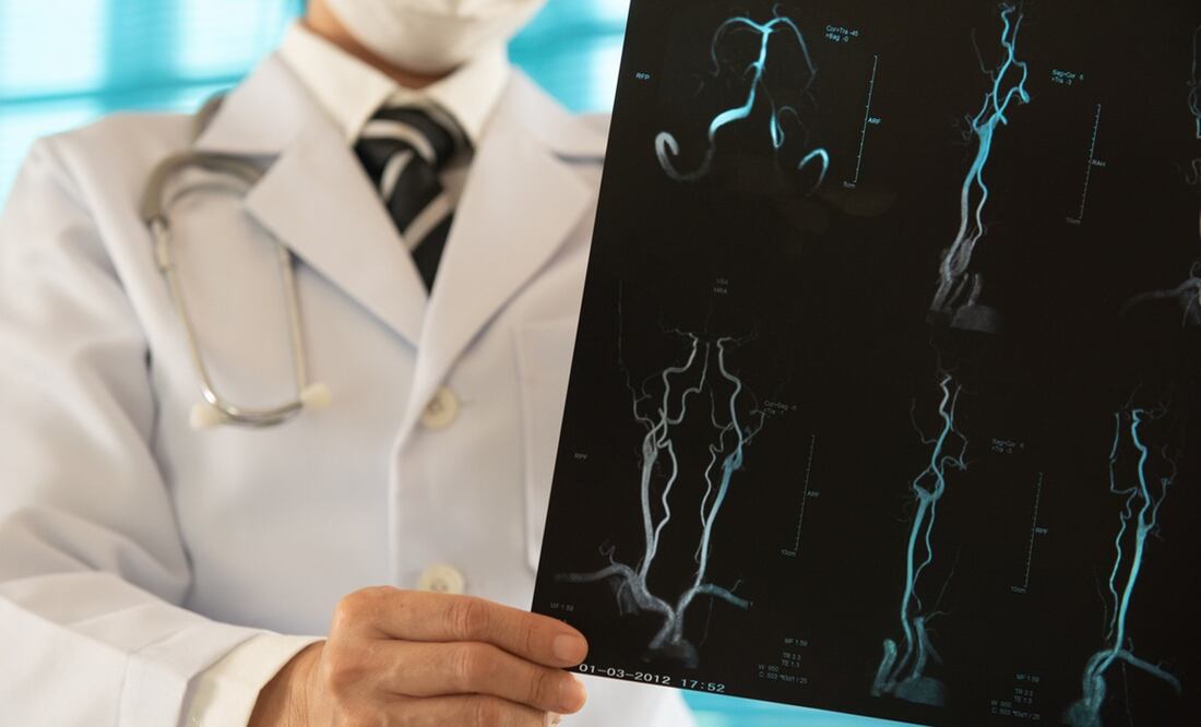 Estudio alerta que 10 millones de personas podrían morir por accidentes cerebrovasculares en 2050. Foto:  iStock-utah778