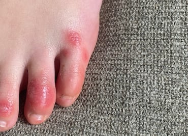 ¿Los moretones en los pies son un síntoma de Covid-19? Esto dicen los expertos