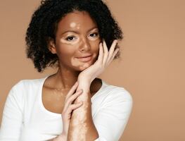 Día Mundial del Vitiligo: ¿Qué lo causa? ¿Hay cura? Esto dice Harvard
