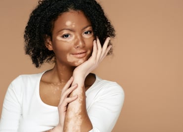 Día Mundial del Vitiligo: ¿Qué lo causa? ¿Hay cura? Esto dice Harvard