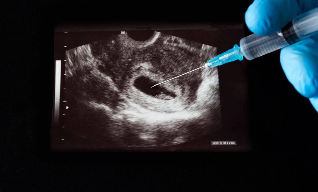 Más de 100,000 abortos en enero en Estados Unidos: efecto de la anulación de Roe contra Wade - Foto: iStock