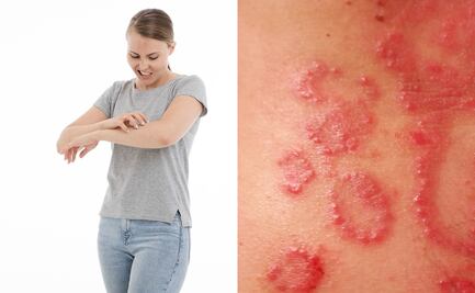 Alteraciones e 'infartos de piel', secuelas en sobrevivientes de Covid-19