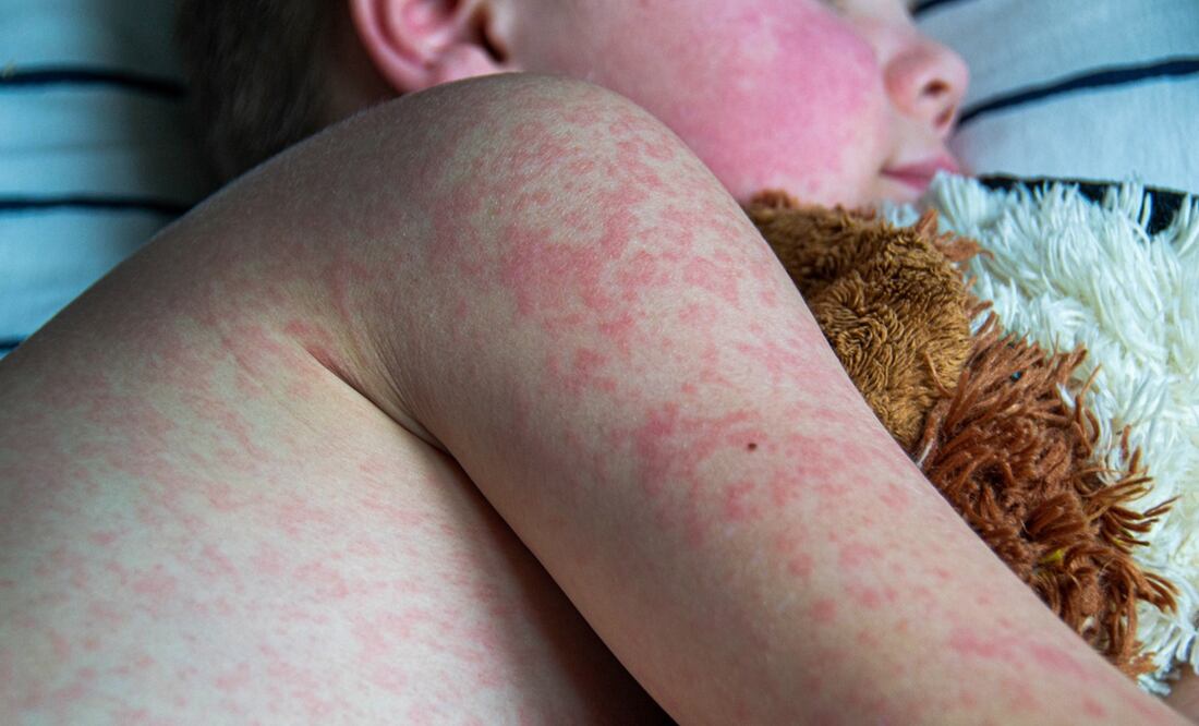 Brote de sarampión en Texas, el más grave en 30 años, podría durar meses Sarampión: iStock/ Povorozniuk Liudmyla