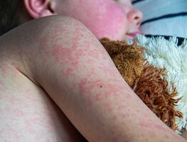 Brote de sarampión en Texas, el más grave en 30 años, podría durar meses