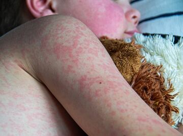 EU reporta menos de 20 casos de sarampión, nuevos brotes encienden alertas