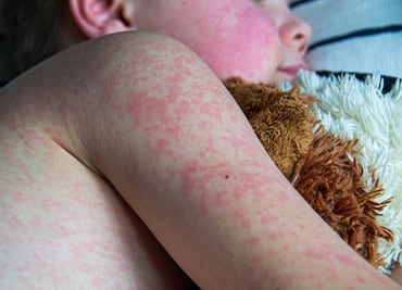 EU reporta menos de 20 casos de sarampión, nuevos brotes encienden alertas