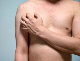 Resurgen casos de sarampión. ¿Qué es y cómo se transmite el virus? Síntomas y vacuna