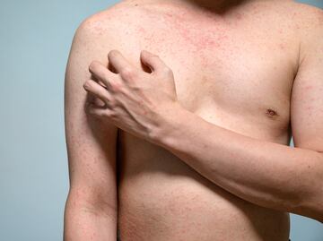 Resurgen casos de sarampión. ¿Qué es y cómo se transmite el virus? Síntomas y vacuna