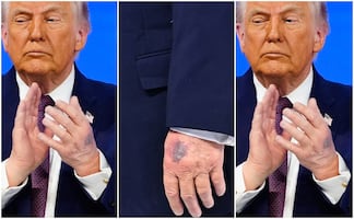 Casa Blanca atribuye moretones de Trump a golpe contra la mesa