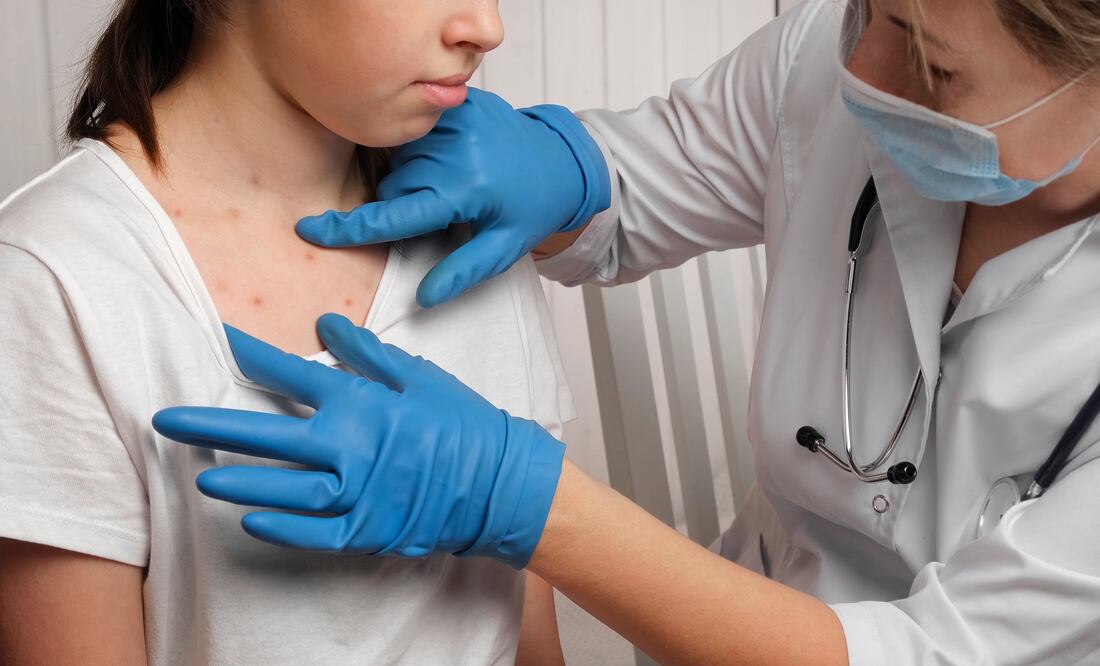 Rubéola se expande en Texas y Nuevo México con hospitalizaciones alarmantes; el brote más grande en 30 años. Foto iStock / Marina Demidiuk