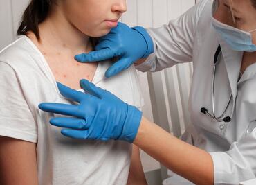 Rubéola se expande en Texas y Nuevo México con hospitalizaciones alarmantes; el brote más grande en 30 años