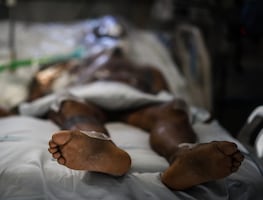 “Hongo negro” llega a Uruguay; infecta a paciente recuperado de Covid