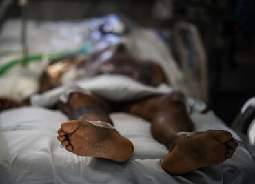 “Hongo negro” llega a Uruguay; infecta a paciente recuperado de Covid