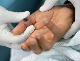 Viruela del mono. Suecia detecta primer caso de la variante más Infecciosa de Mpox