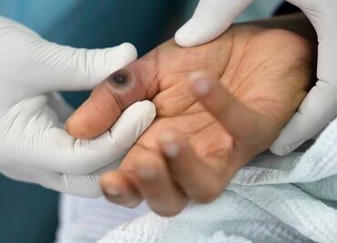 Virus de la viruela del mono podría transmitirse por vía aérea