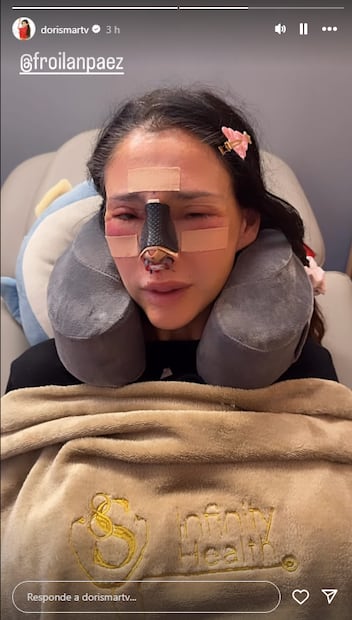 Dorismar revela que fue víctima de una cirugía estética mal realizada. Foto: Tomada de Instagram @dorismartv