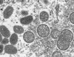 Viruela del mono: Casos podrían ser la “punta del iceberg”: OMS