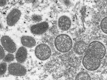 Viruela del mono: Casos podrían ser la “punta del iceberg”: OMS