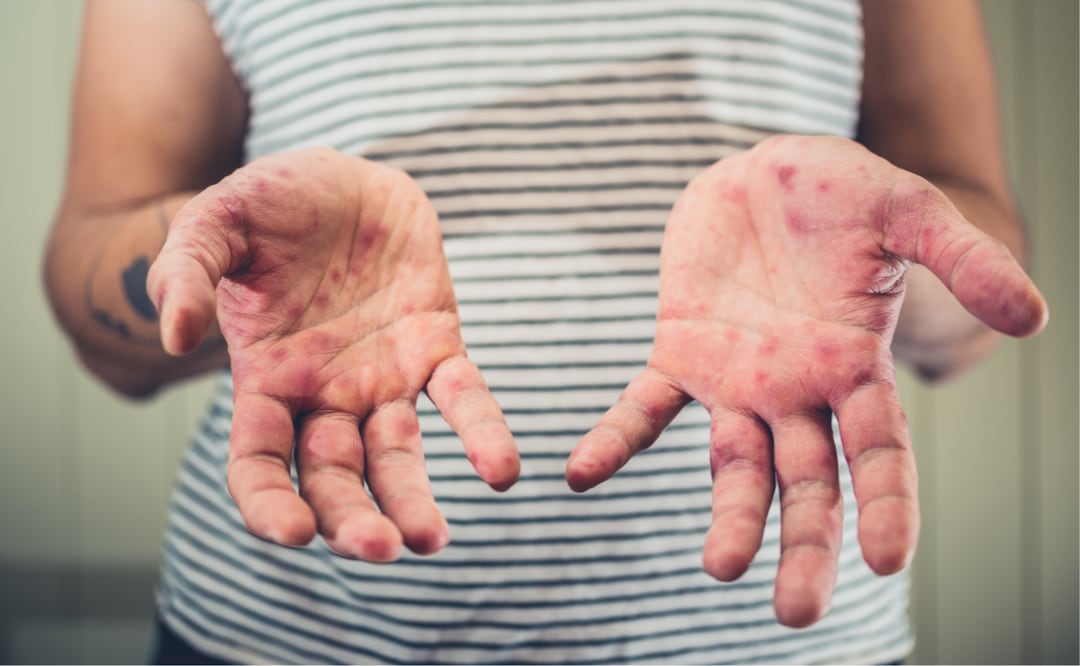 Detectan 21 casos de sarampión en México. ¿Cuáles son los síntomas y las diferencias con la varicela? Foto: Canva/Lolostock