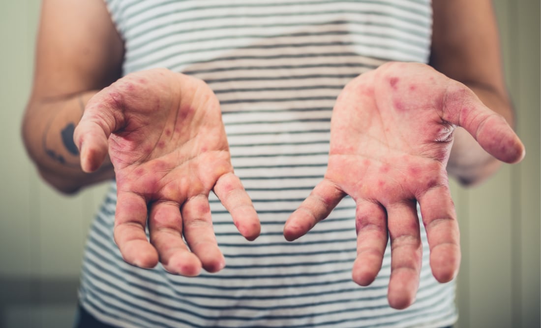 Alerta sanitaria en EU: Hombre con sarampión viajó en tren y podría haber contagiado a pasajeros. Foto: Canva/Lolostock