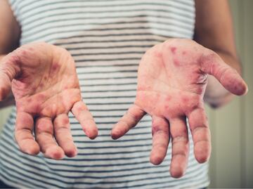 Alerta por sarampión en México. ¿Cuáles son los síntomas y las diferencias con la varicela?