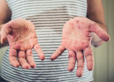 Alerta sanitaria en EU: Hombre con sarampión viajó en tren y podría haber contagiado a pasajeros