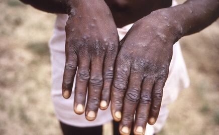 Viruela del mono. Urgen a países con reservas de vacunas Mpox a donar dosis a África