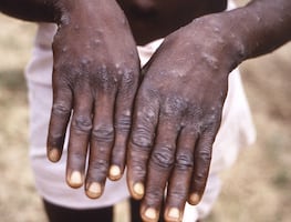 Viruela del mono. Urgen a países con reservas de vacunas Mpox a donar dosis a África