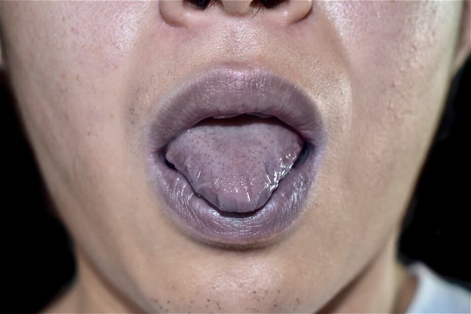 Lengua con tonalidades oscuras. iStock/Zay Nyi Nyi
