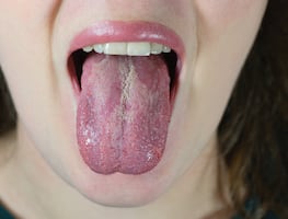 Lo que el color de tu lengua dice sobre tu salud, según Harvard