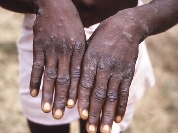 Viruela del mono podría haber cambiado su forma de contagio, advierten