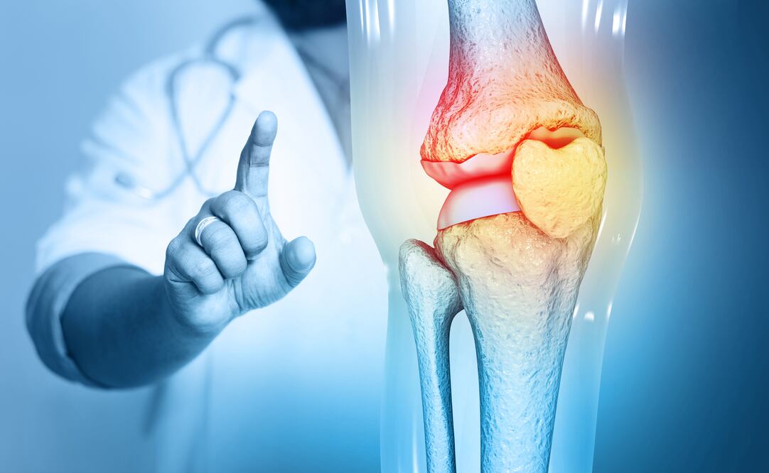 Osteoartritis/ iStock/Mohammed Haneefa Nizamudeen