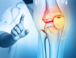 Mil millones de personas sufrirán osteoartritis en 2050