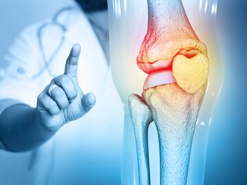 Mil millones de personas sufrirán osteoartritis en 2050