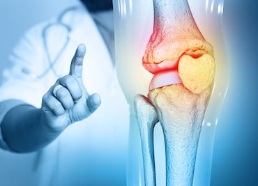 Mil millones de personas sufrirán osteoartritis en 2050