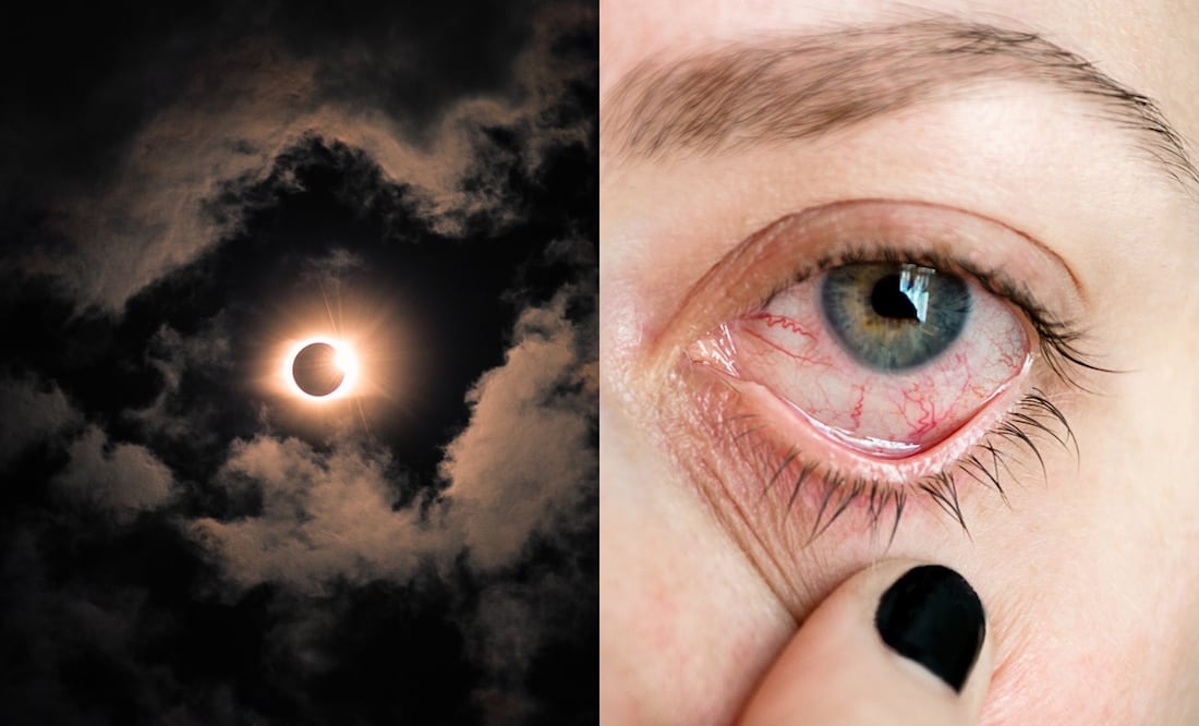 Daño ocular por eclipse solar. Foto: iStock/ Wirestock/ shutnica