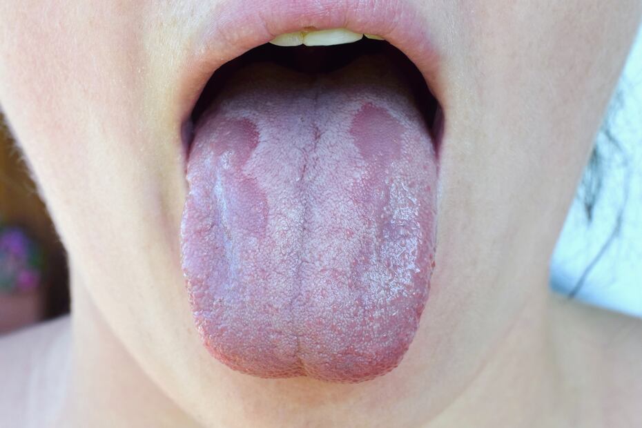 Lengua con manchas blancas. iStock/Tunatura