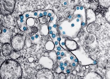 Cóctel de anticuerpos monoclonales 'neutraliza' el Covid-19