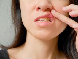 Despídete del dolor:  5 efectivos remedios caseros para eliminar las aftas en la boca