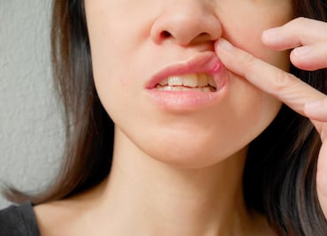 Despídete del dolor: 5 efectivos remedios caseros para eliminar las aftas en la boca