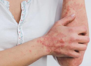 Estados Unidos detecta un primer caso de viruela del mono