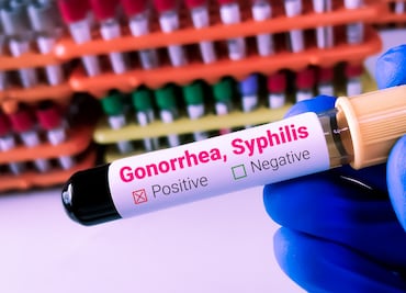 Estados Unidos enfrenta epidemia de Infecciones de Transmisión Sexual (ITS). ¿Qué es y cuáles son los síntomas?