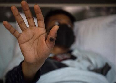 Casos de viruela del mono aumentan hasta 160% en África y alertan por riesgo de más propagación