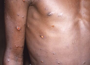 Viruela del mono puede detenerse en países no endémicos: OMS