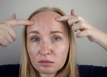 ¿Por qué salen manchas blancas en la piel? ¿Cómo se quitan? Esto dice Cleveland Clinic