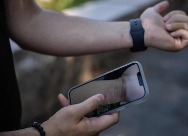 Viruela del mono: 8 maneras comprobadas en las que se contagia (CDC)