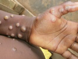Detectan caso de viruela del mono en residente de Maryland